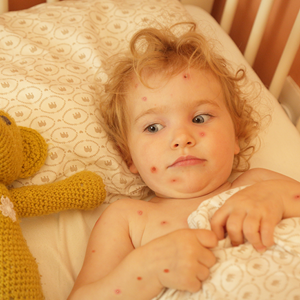 La-varicela-en-los-bebes