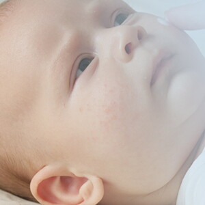 Alergias en niños y bebés